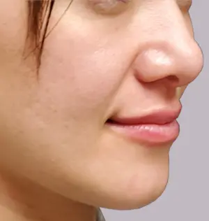 gal3-after